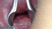 Bokep Video Asian Jav Pregnancy with Semen Injection in Cervix for Impregnation and Endoscopic Cam in Uterus to see inner mp4